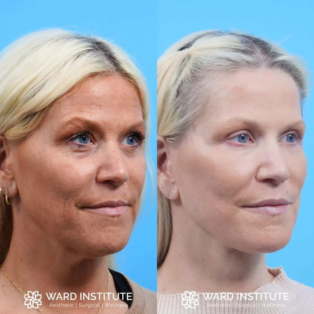 Female facelift before and after photo.