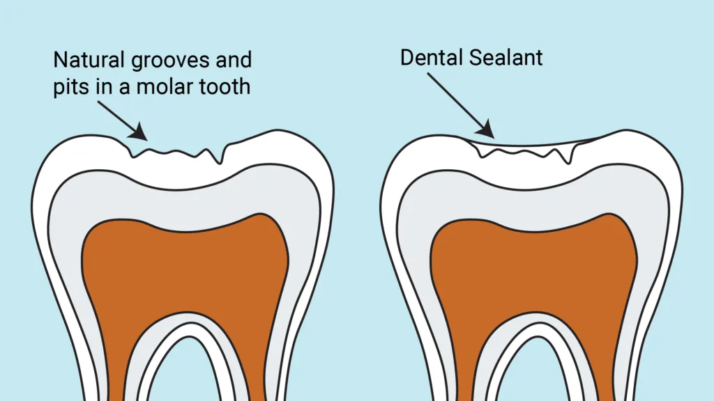 sealants