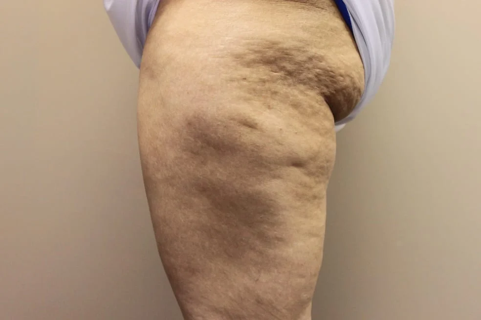 Cellulite before treatment