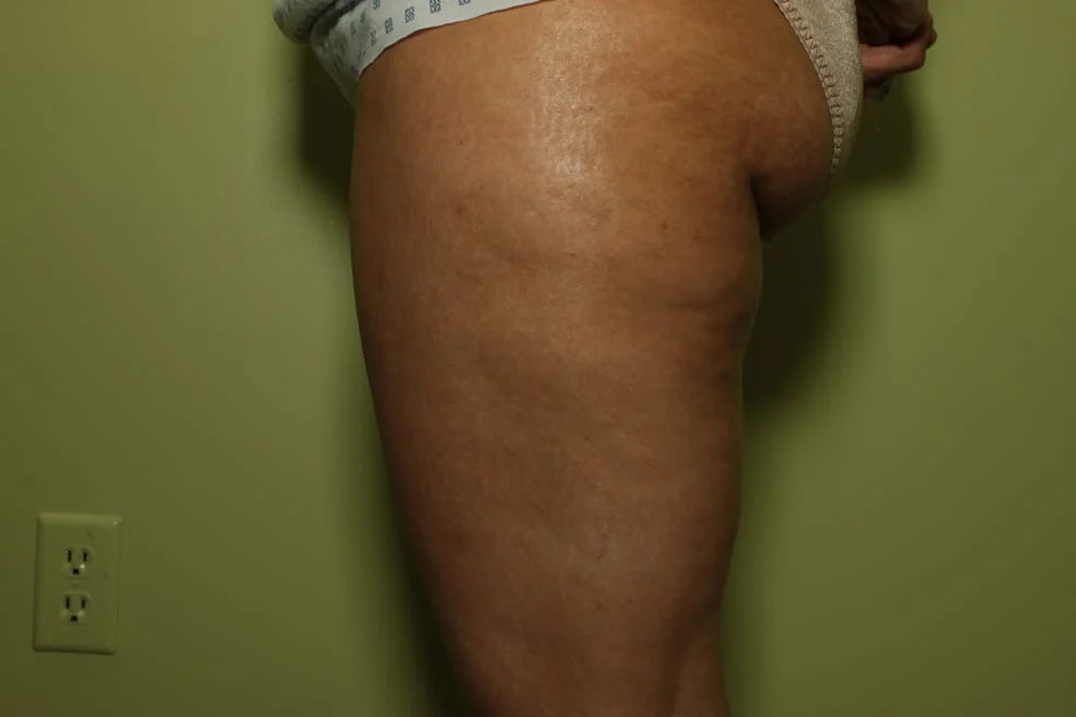 Cellulite after alma treatment