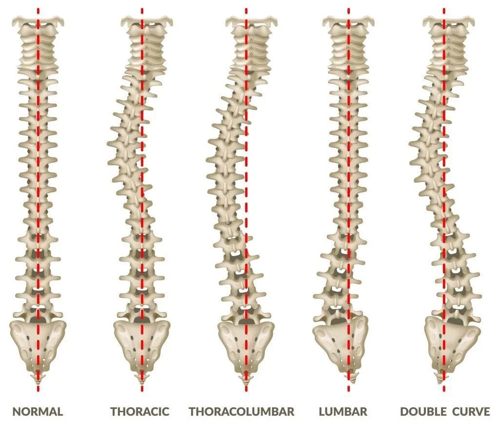 scoliosis types 