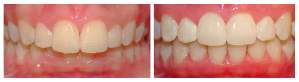 before and after of overbite correction with Invisalign treatment Westminster, MD