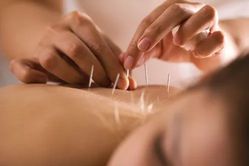 Medical Acupuncture