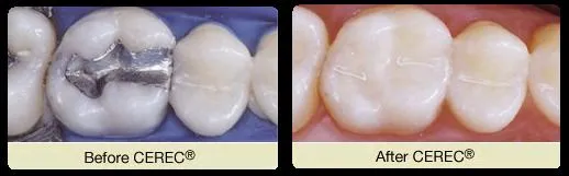 CEREC Before and After - Glen Cove, NY Dentist | Joseph M. Buono, DDS