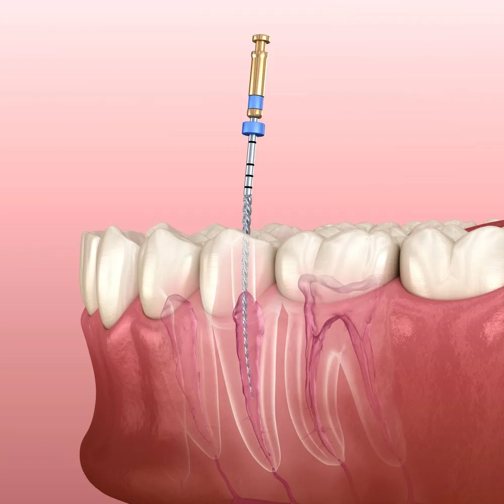 endodontics