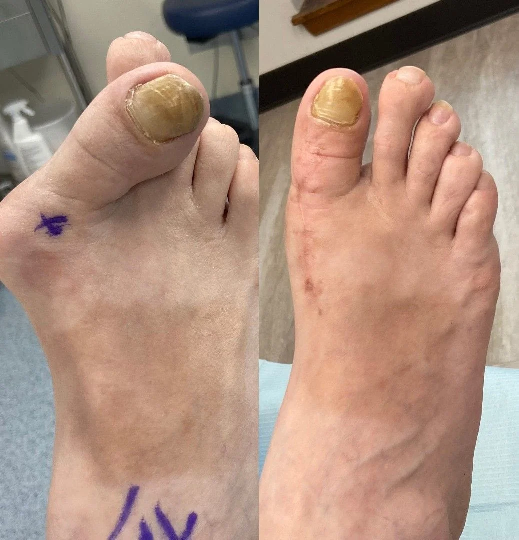 Severe Bunion Deformity Repaired with MT Fusion Pre Op and Post Op