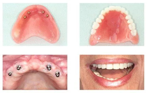 all on 4 implant dentures, implant dentistry Brookline, MA dentist