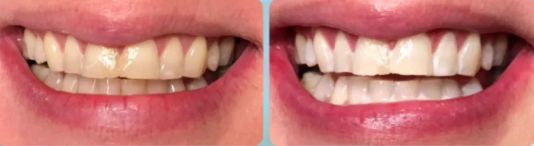 Whitening Patient