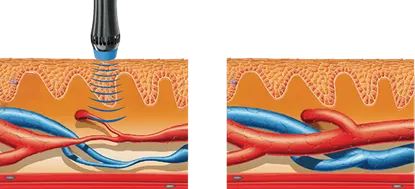 Shock Wave Vascular Change