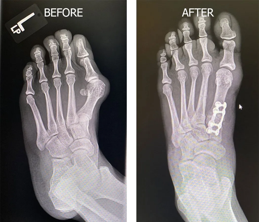 Lapiplasty 3D Bunion Correction Arizona Foot & Ankle Surgery