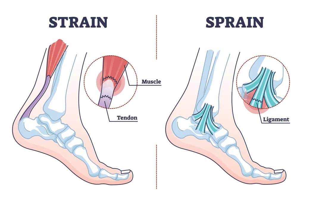 strain vs sprain