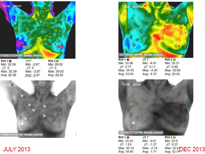 thermography