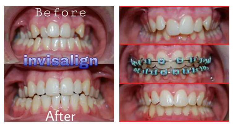 Before & After Invisalign