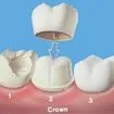 diagram of crown capping a tooth, Issaquah, WA dental crown