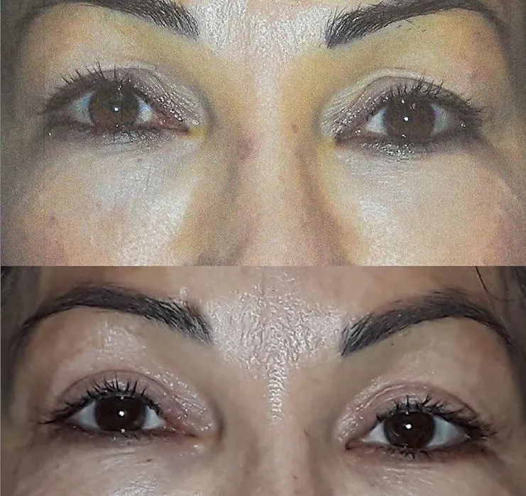 Blepharoplasty