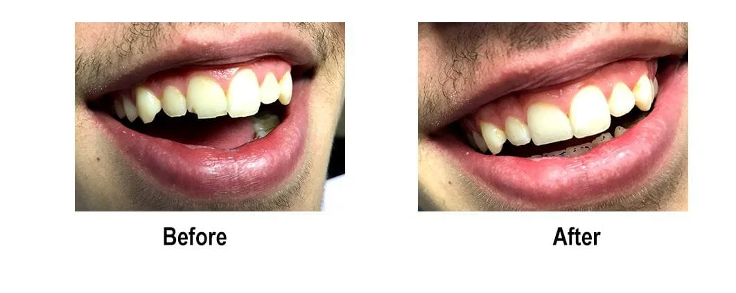 Before and After Dental Photos - Smile Makeovers
