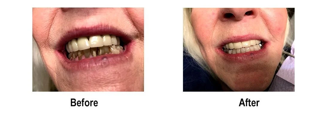 Before and After Dental Photos - Smile Makeovers