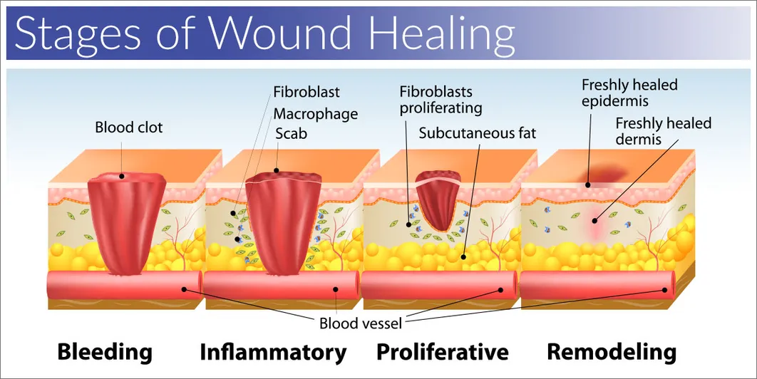 woundhealing