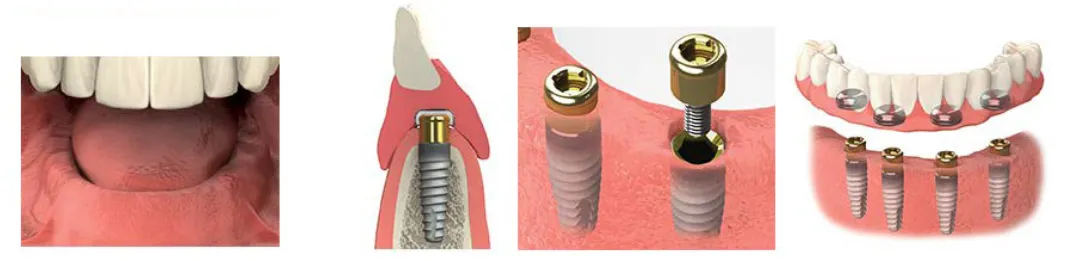 mutiple-dental-implant