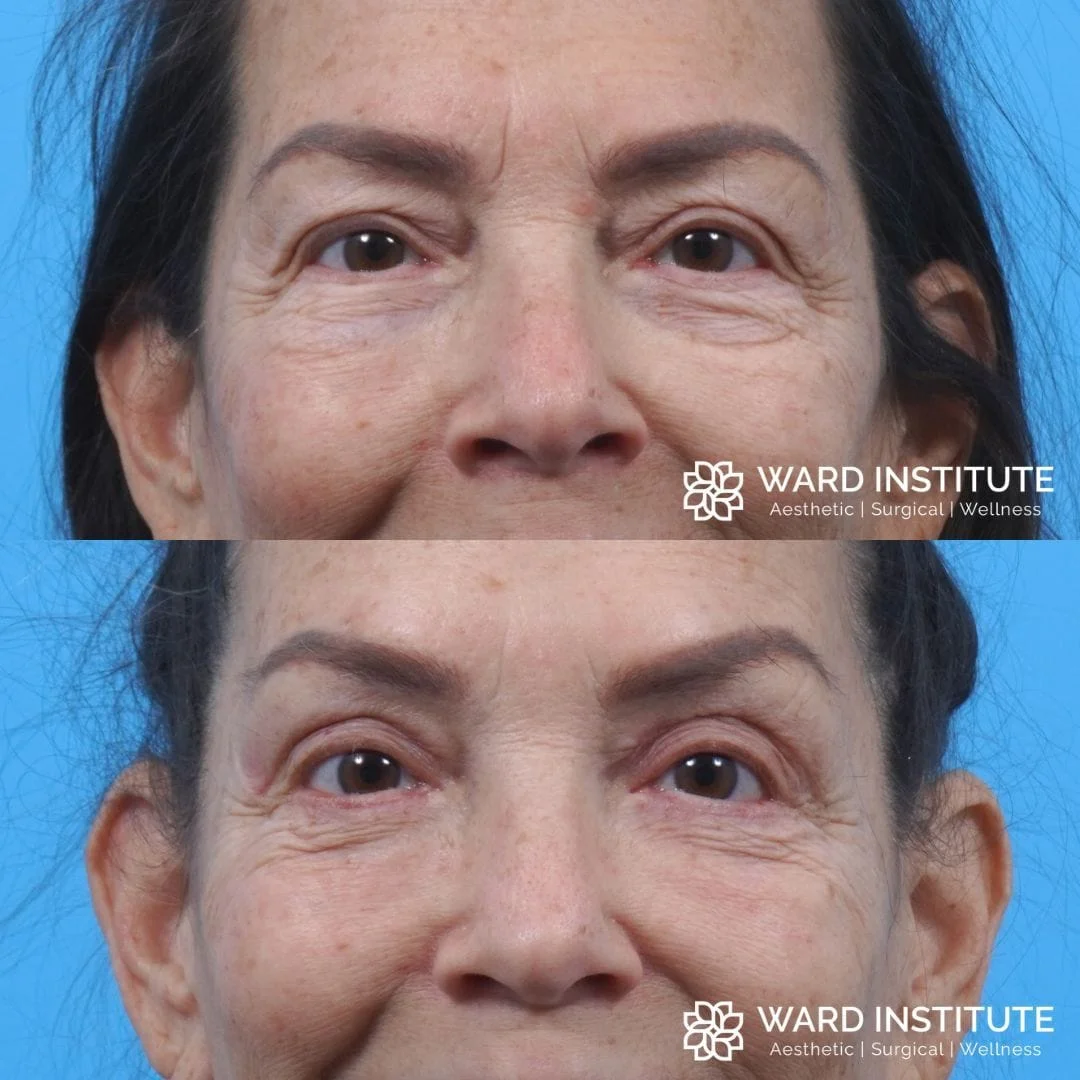 Eyelid lift before and after image.