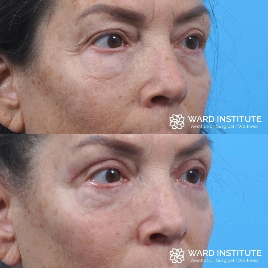 Female blepharoplasty before and after image.