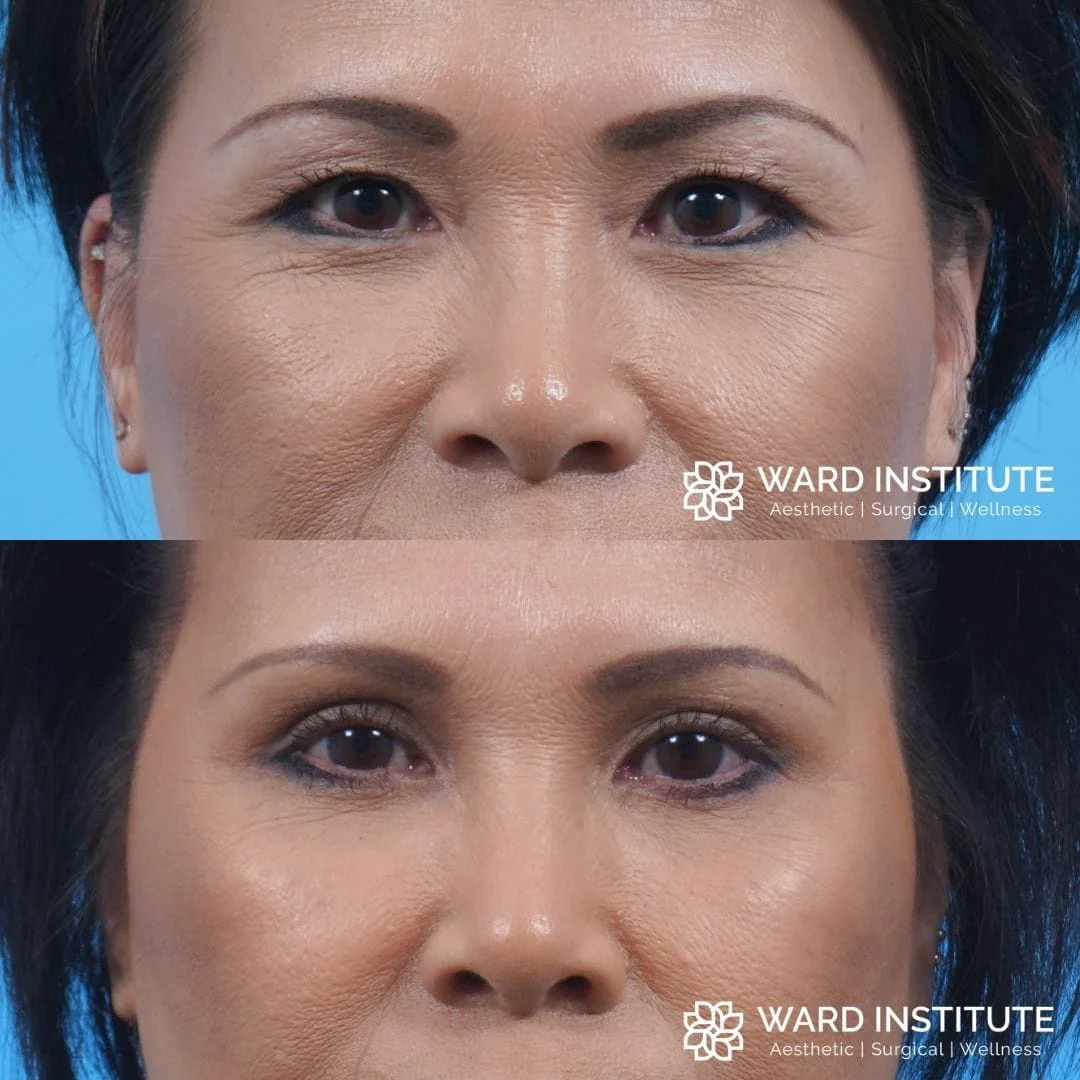 Female blepharoplasty before and after image.