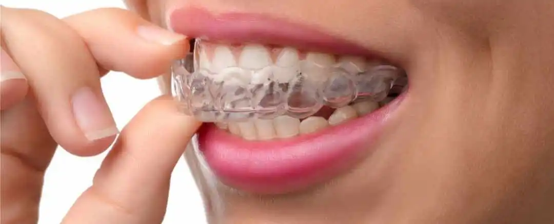 Invisalign Burlington, NC