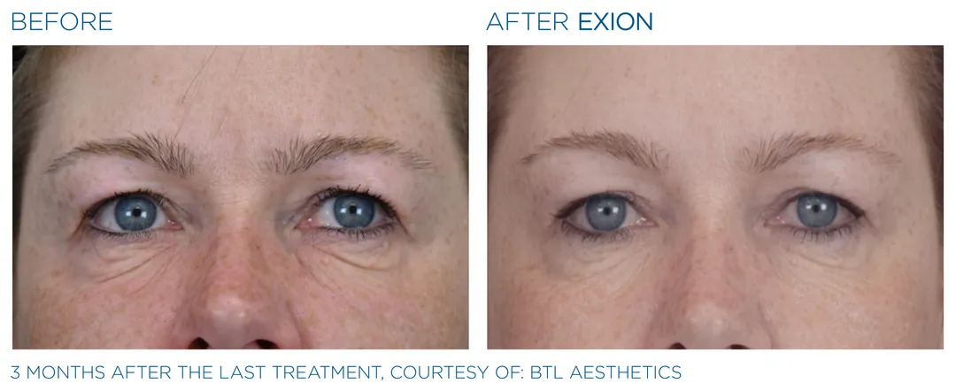 skin tightening treatment with exion in winter park, florida