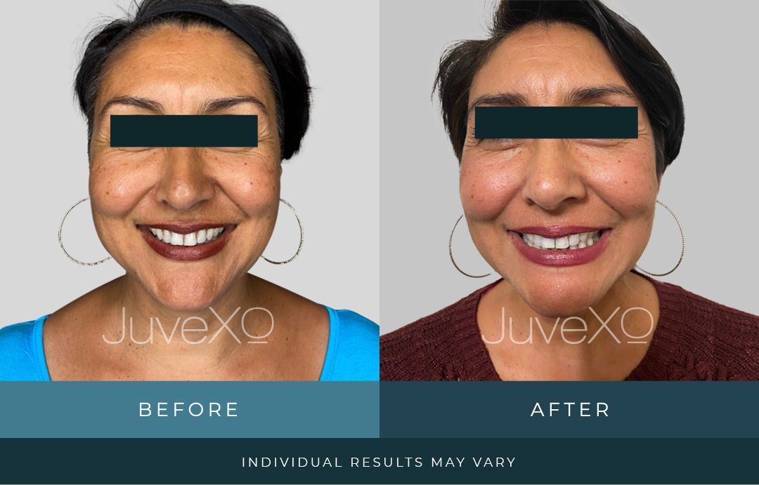 Before and After