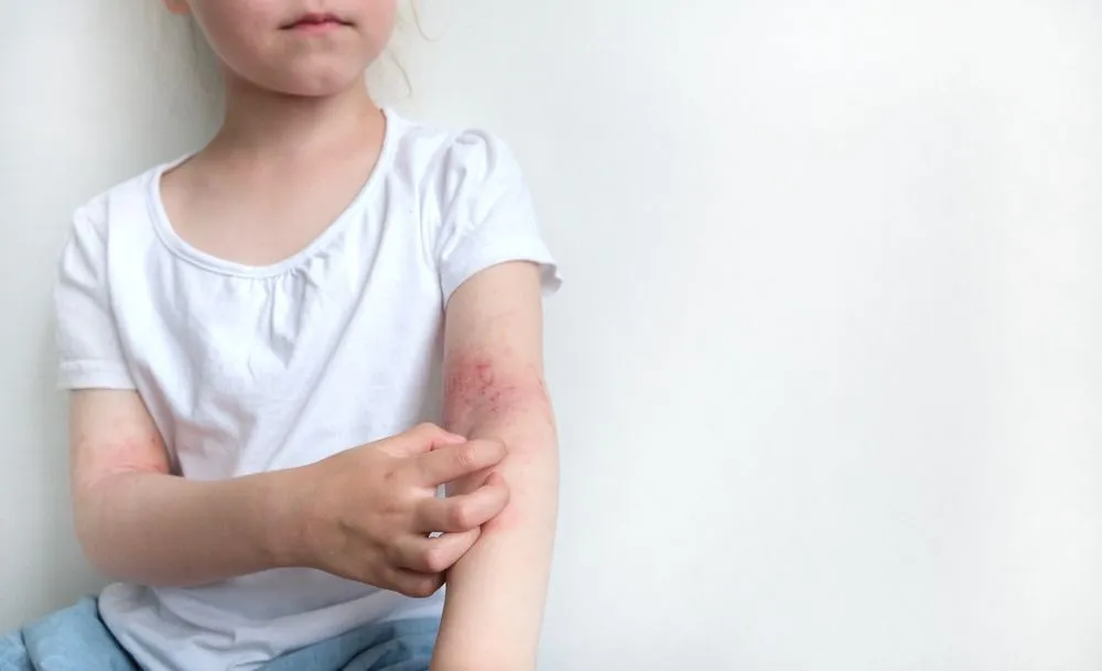 child scratches Eczema