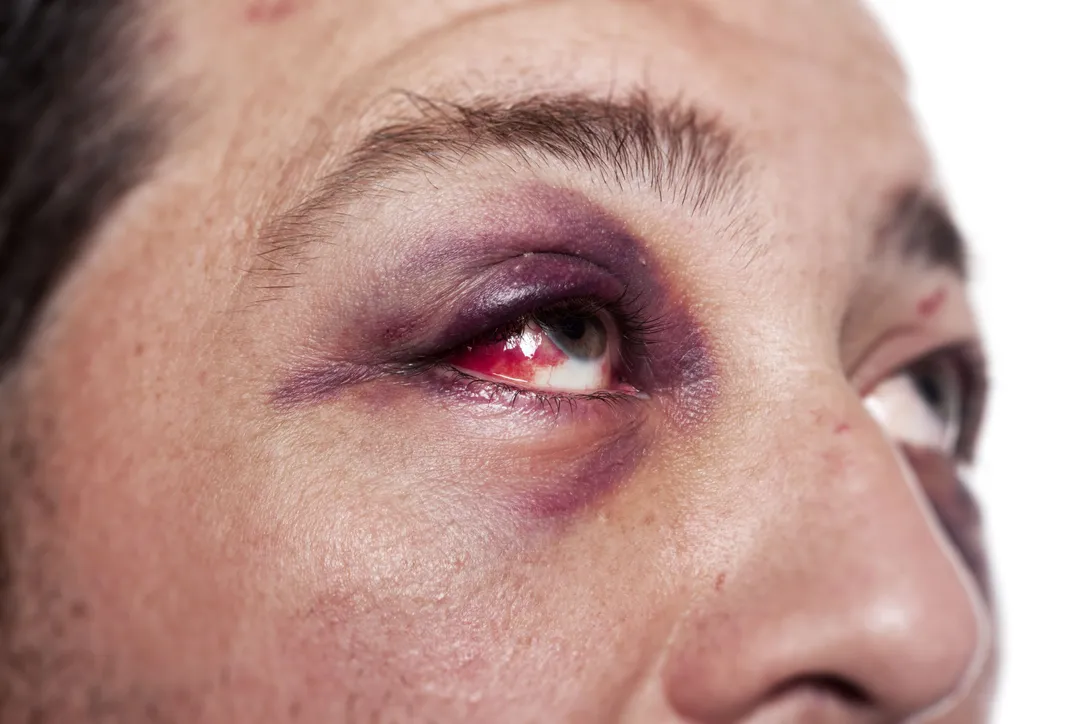 Eye Injuries