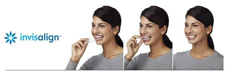 invisalign header