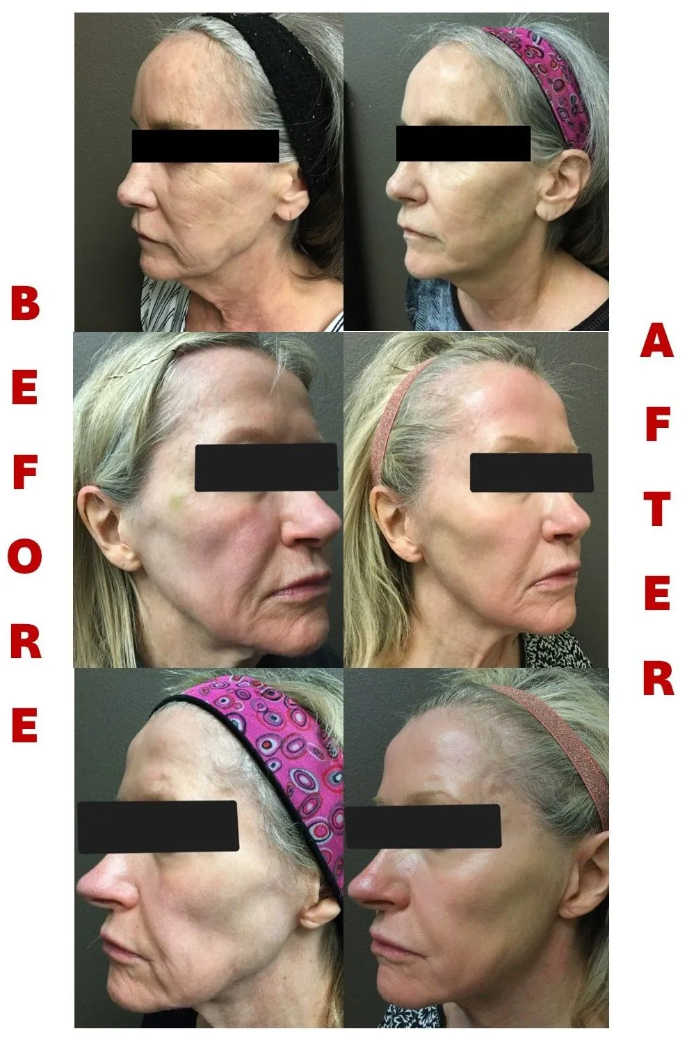Sculptra Before & After