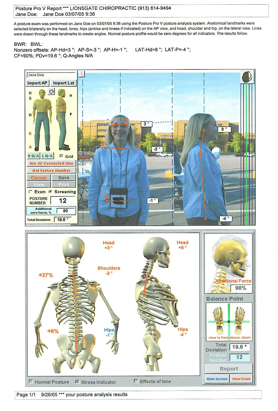 Computerized Posture Scan Report Showing the Bend of a Person's Spine