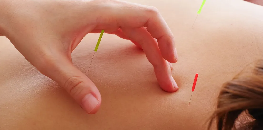 dry needling