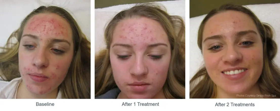 girl derm skin 
