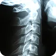 An x-ray image of one's cervical spine during chiropractic first visit.
