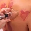 Love Cupping
