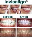 invisalign_pic1.png