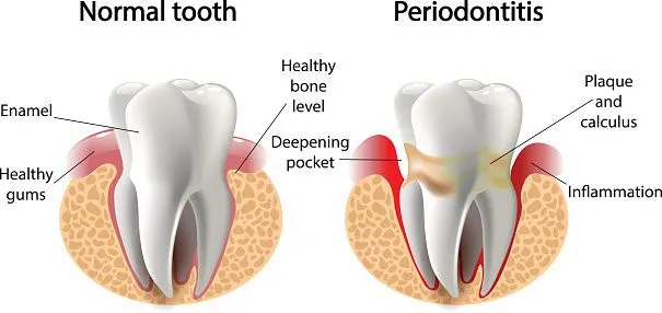 Gum Disease