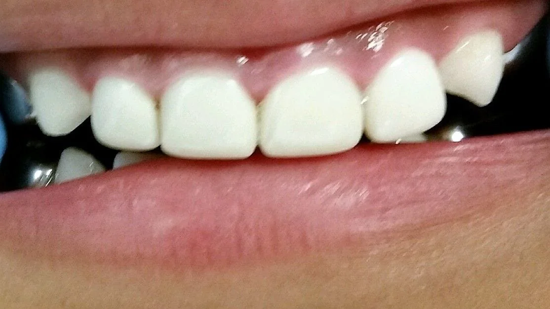 example of esthetic crowns for primary teeth