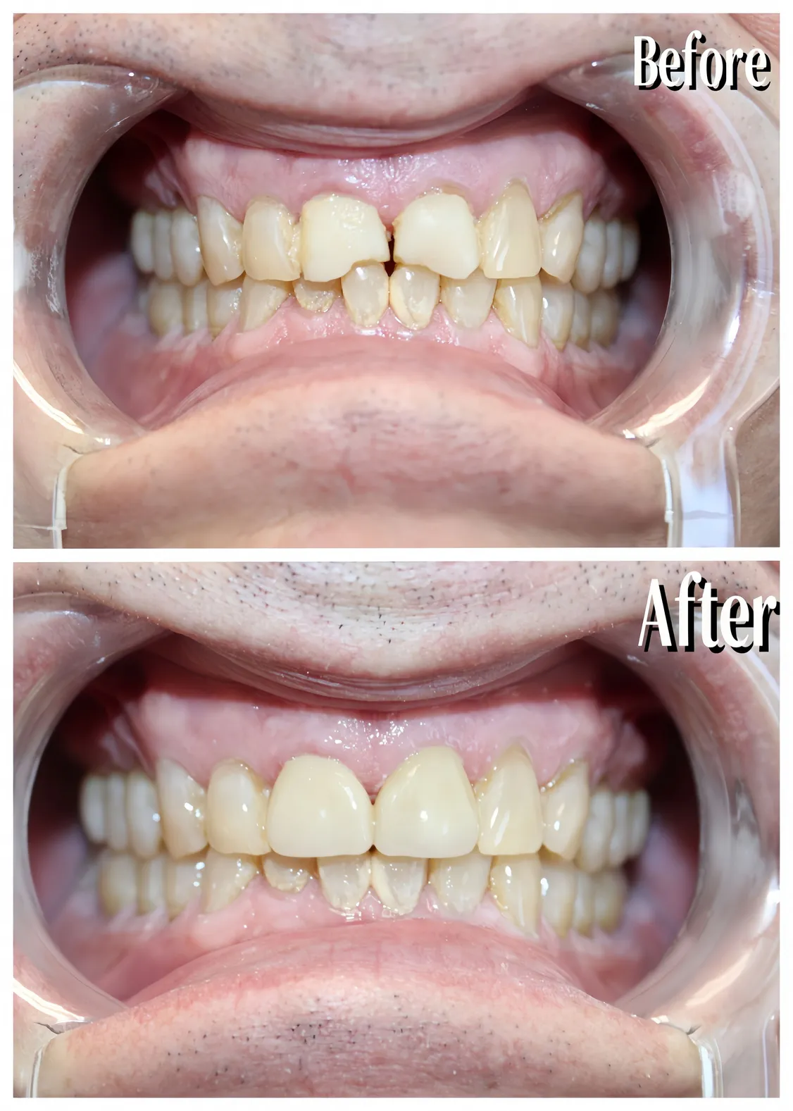 #8 #9 pre and post crown