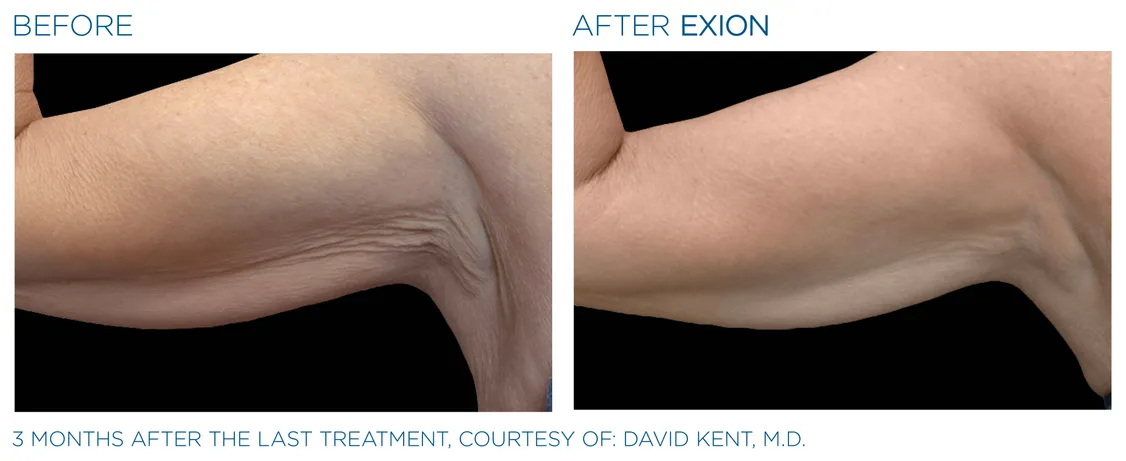 skin tightening treatment with exion in winter park, florida