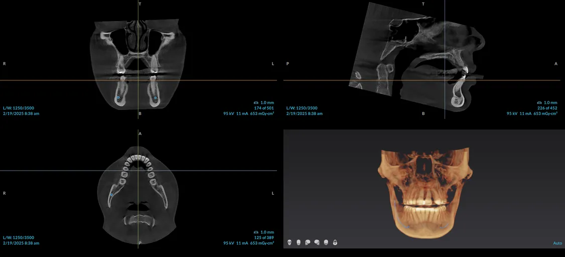 CBCT image