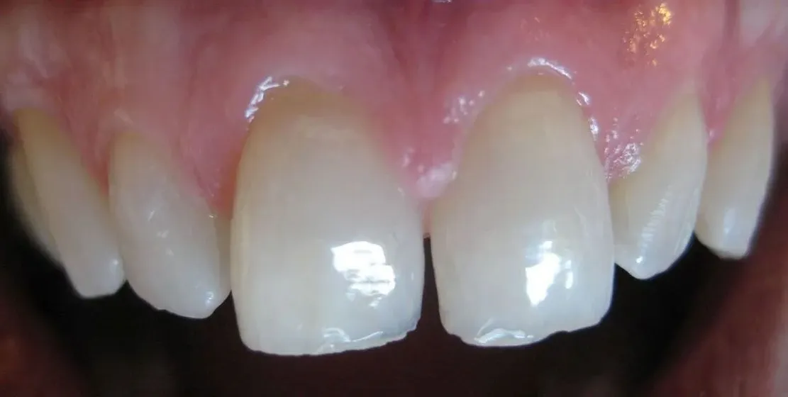 Pre-Op: Patient did not like shape and color of natural teeth