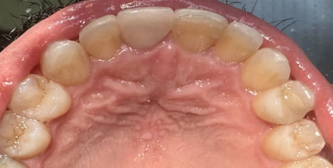 Post-Invisalign: Patient was compliant with invisalign trays for the 12 month treatment course 