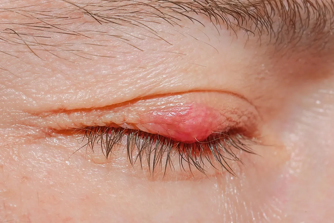 Stye Eye