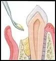 Crown Lengthening