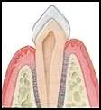 Crown Lengthening