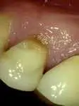 before photo of very common gumline recession where the dark tooth roots show 